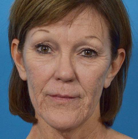 Facelift before at JK Plastic Surgery in Frisco, TX