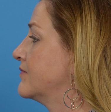 JK Plastic Surgery rhinoplasty after — Frisco, TX