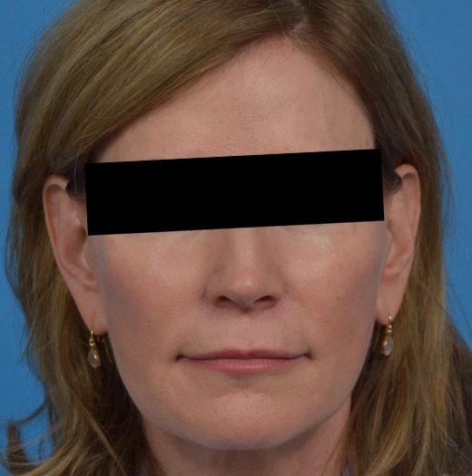 Facelift after at JK Plastic Surgery in Frisco, TX