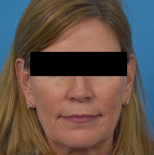 Facelift before at JK Plastic Surgery in Frisco, TX