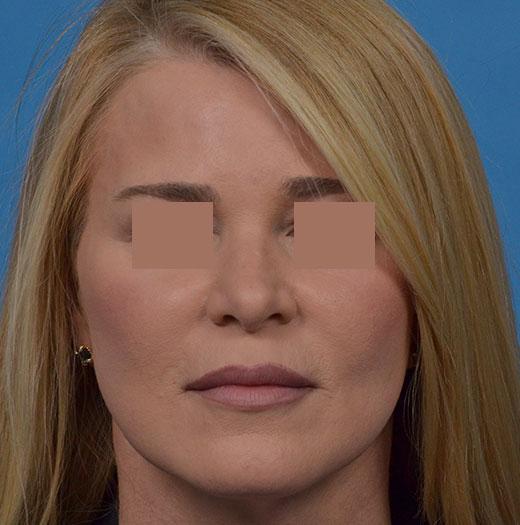 JK Plastic Surgery facelift after — Frisco, TX