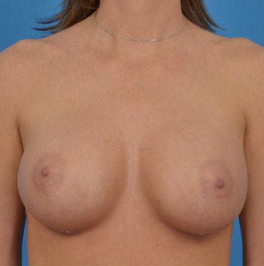 Breast Augmentation after at JK Plastic Surgery in Frisco, TX