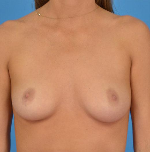 Breast Augmentation before at JK Plastic Surgery in Frisco, TX