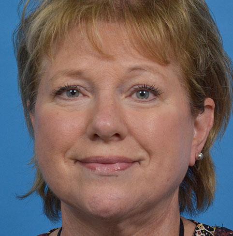 Facelift after at JK Plastic Surgery in Frisco, TX
