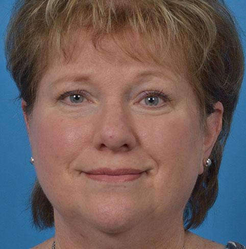 Facelift before at JK Plastic Surgery in Frisco, TX