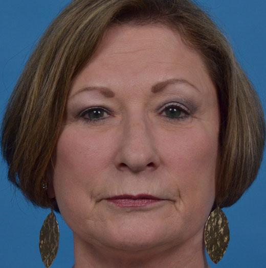 Facelift after at JK Plastic Surgery in Frisco, TX