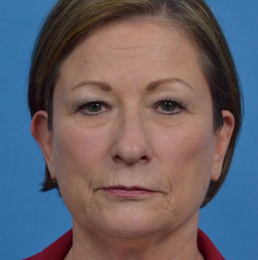 Facelift before at JK Plastic Surgery in Frisco, TX
