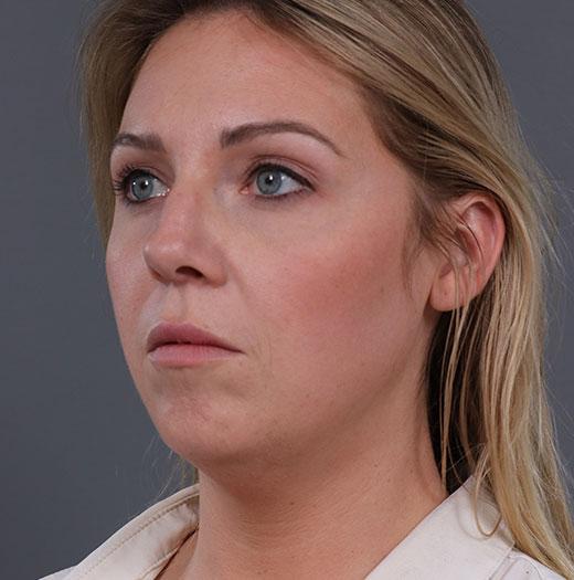 Chin Implant before at JK Plastic Surgery in Frisco, TX