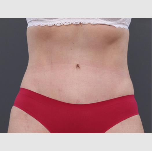 JK Plastic Surgery tummy tuck after — Frisco, TX