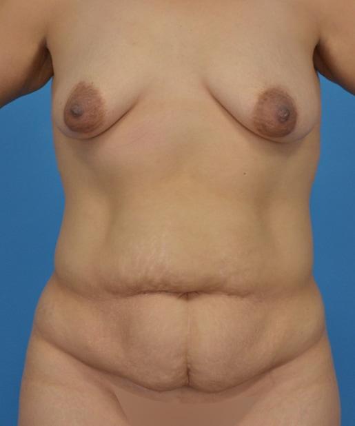 Mommy Makeover before at JK Plastic Surgery in Frisco, TX