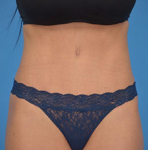 JK Plastic Surgery tummy tuck after — Frisco, TX