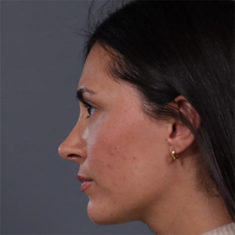 Revision Rhinoplasty after at JK Plastic Surgery in Frisco, TX