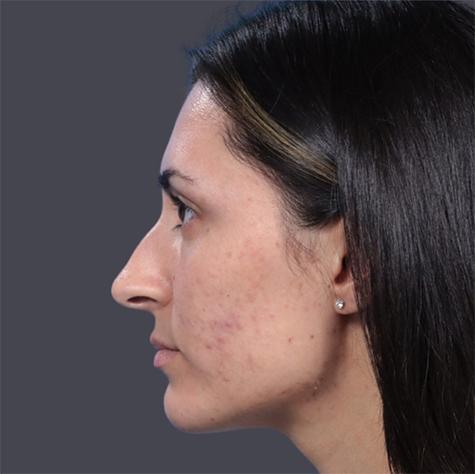 Revision Rhinoplasty before at JK Plastic Surgery in Frisco, TX