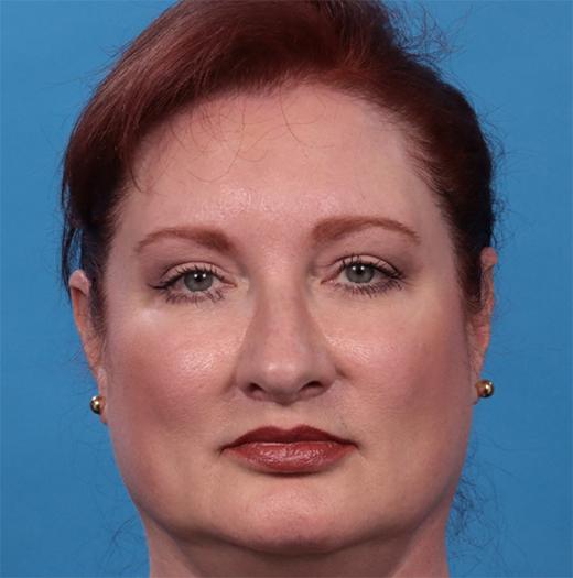 Blepharoplasty after at JK Plastic Surgery in Frisco, TX