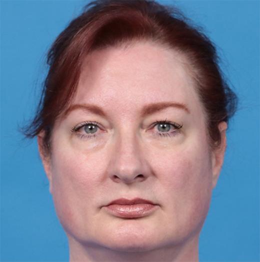 Blepharoplasty before at JK Plastic Surgery in Frisco, TX