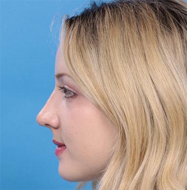 Revision Rhinoplasty after at JK Plastic Surgery in Frisco, TX