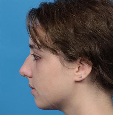 Revision Rhinoplasty before at JK Plastic Surgery in Frisco, TX