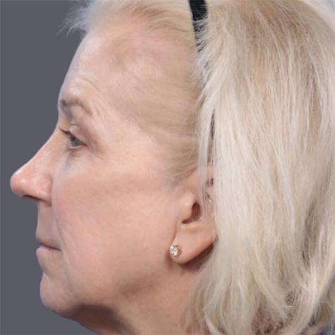 Revision Rhinoplasty after at JK Plastic Surgery in Frisco, TX