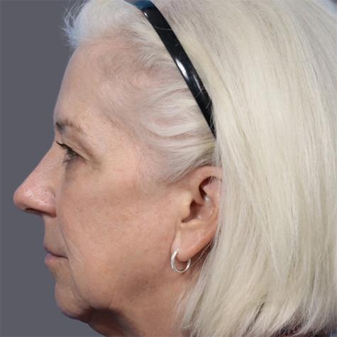 Revision Rhinoplasty before at JK Plastic Surgery in Frisco, TX