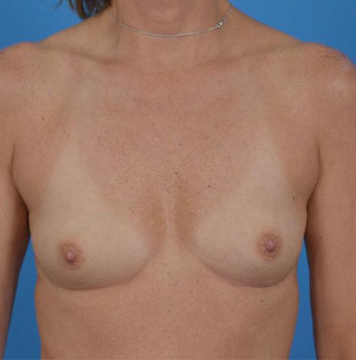 Breast Augmentation before at JK Plastic Surgery in Frisco, TX