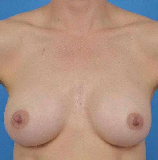 JK Plastic Surgery breast augmentation after — Frisco, TX