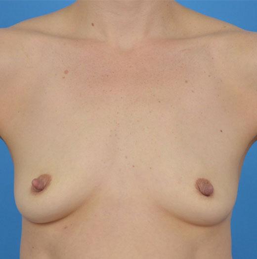 Breast Augmentation before at JK Plastic Surgery in Frisco, TX