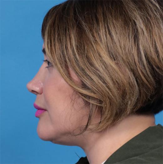 Neck Lift after at JK Plastic Surgery in Frisco, TX