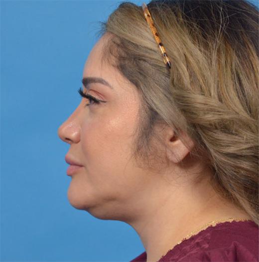 Neck Lift before at JK Plastic Surgery in Frisco, TX
