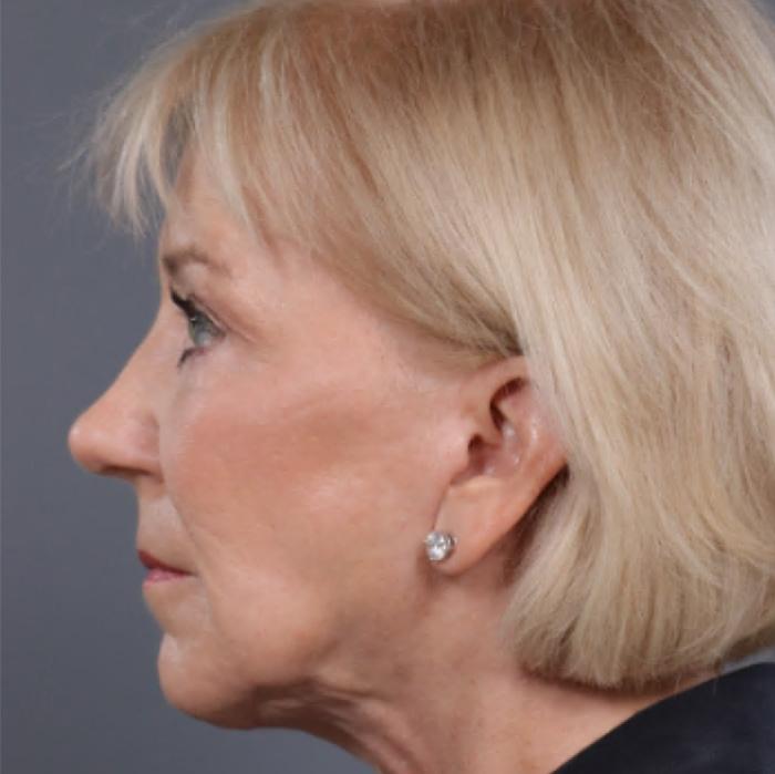 JK Plastic Surgery chin implant after — Frisco, TX
