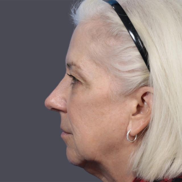 Chin Implant before at JK Plastic Surgery in Frisco, TX