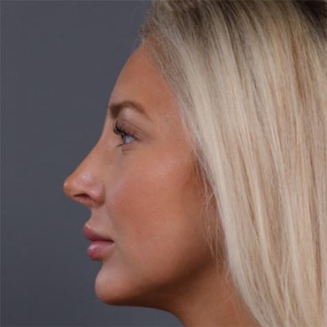 Revision Rhinoplasty after at JK Plastic Surgery in Frisco, TX