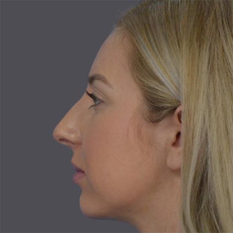 Revision Rhinoplasty before at JK Plastic Surgery in Frisco, TX