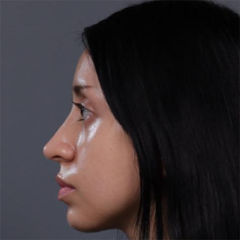 Revision Rhinoplasty after at JK Plastic Surgery in Frisco, TX