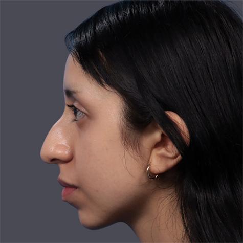 Revision Rhinoplasty before at JK Plastic Surgery in Frisco, TX