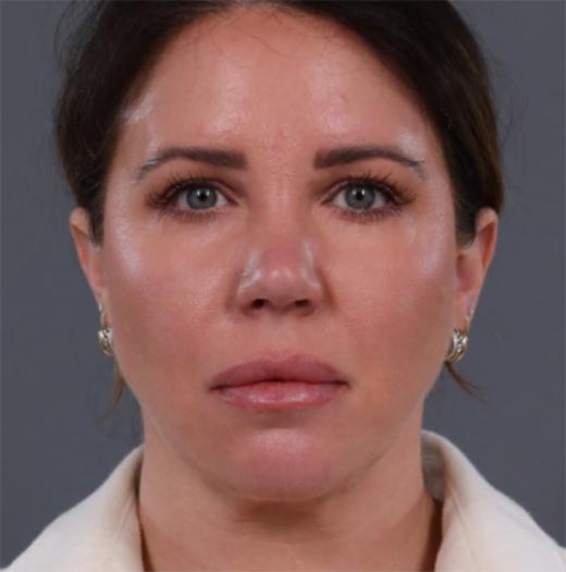 JK Plastic Surgery facelift after — Frisco, TX