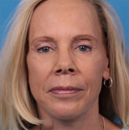 Neck Lift after at JK Plastic Surgery in Frisco, TX