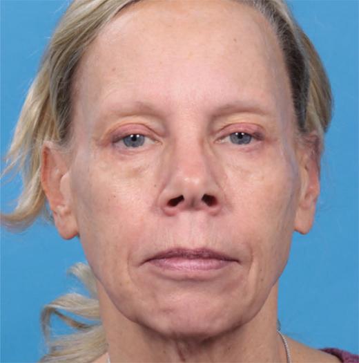 Neck Lift before at JK Plastic Surgery in Frisco, TX