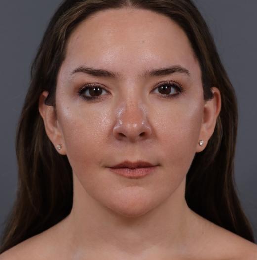 Neck Lift after at JK Plastic Surgery in Frisco, TX