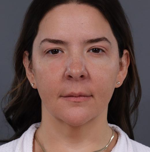 Neck Lift before at JK Plastic Surgery in Frisco, TX