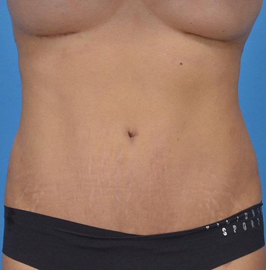 JK Plastic Surgery tummy tuck after — Frisco, TX