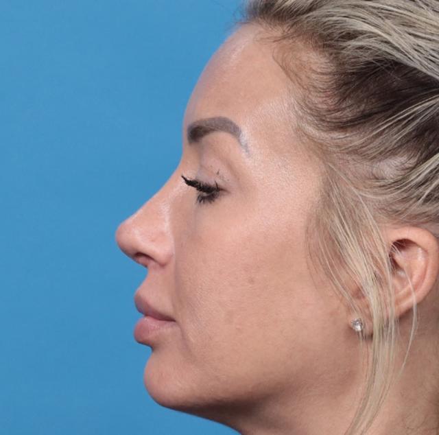 Revision Rhinoplasty after at JK Plastic Surgery in Frisco, TX