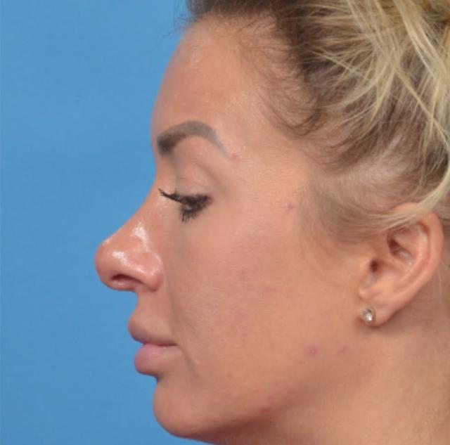 Revision Rhinoplasty before at JK Plastic Surgery in Frisco, TX