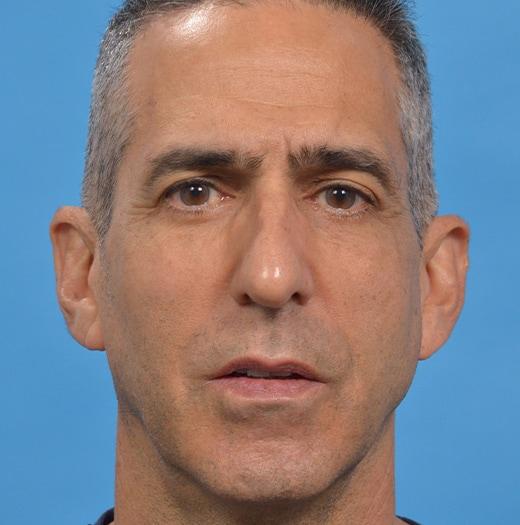 Blepharoplasty after at JK Plastic Surgery in Frisco, TX