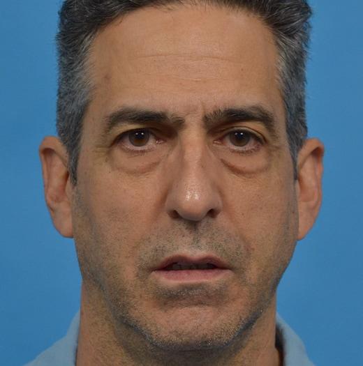 Blepharoplasty before at JK Plastic Surgery in Frisco, TX