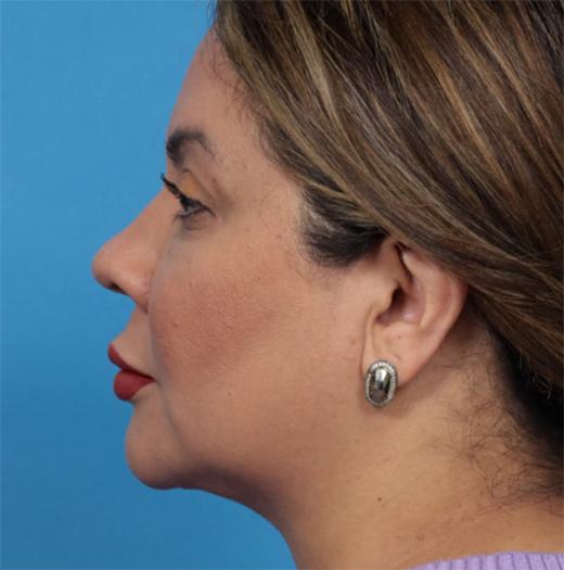 Neck Lift after at JK Plastic Surgery in Frisco, TX
