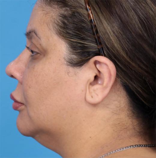 Neck Lift before at JK Plastic Surgery in Frisco, TX