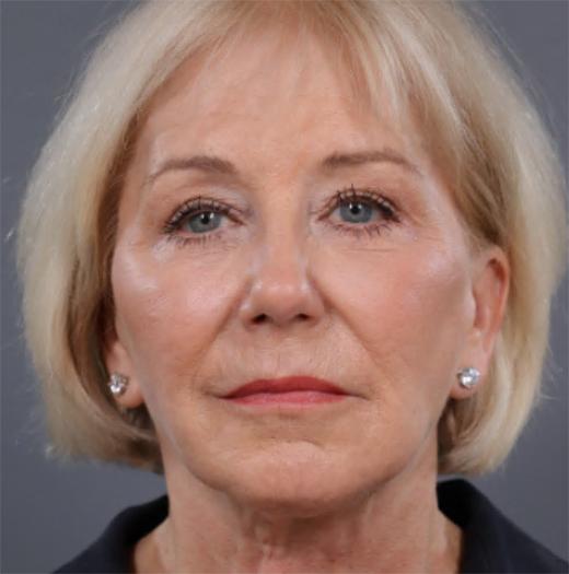 Facelift after at JK Plastic Surgery in Frisco, TX