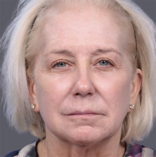 Facelift before at JK Plastic Surgery in Frisco, TX