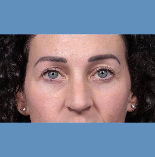 Blepharoplasty after at JK Plastic Surgery in Frisco, TX