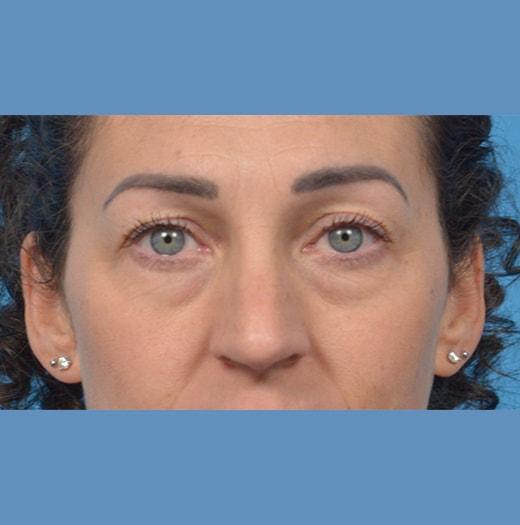 Blepharoplasty before at JK Plastic Surgery in Frisco, TX